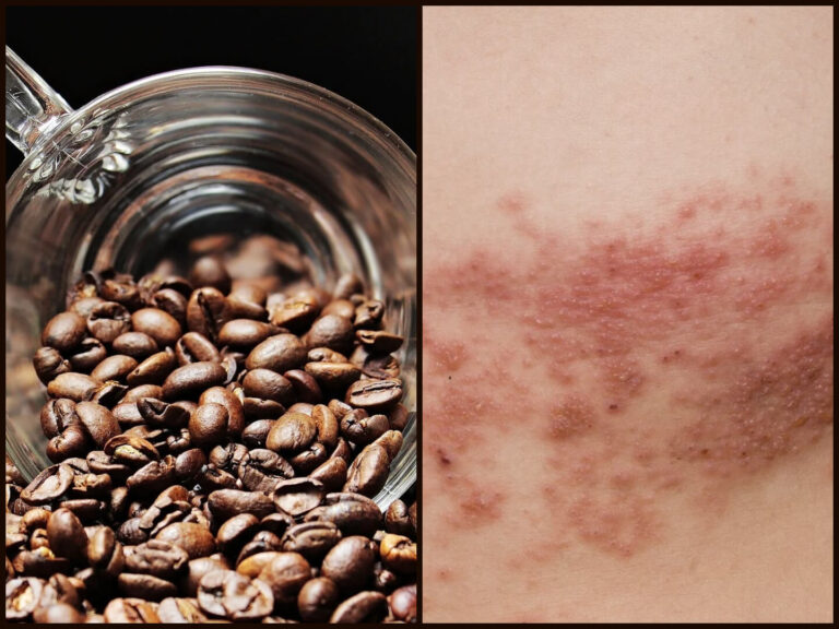 warum kein kaffee bei gürtelrose